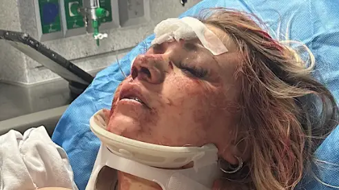 Bride-to-be ‘violently assaulted’ on hen-night leaving her ‘unconscious’ with broken nose weeks before wedding