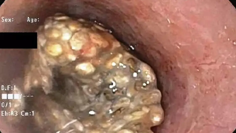 (American College of Gastroenterology)