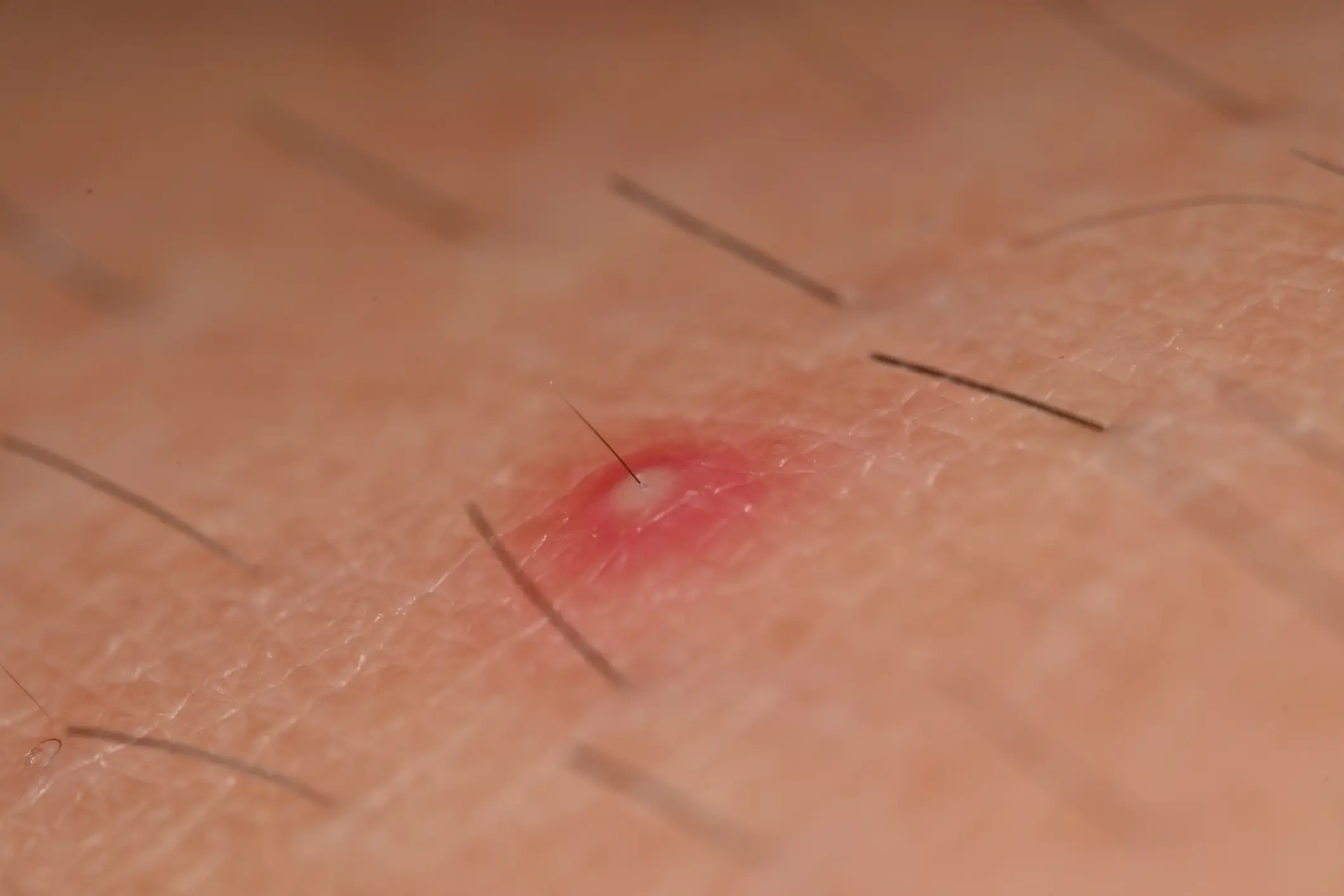 Yerin Ha revealed she got folliculitis (Getty Stock Images)