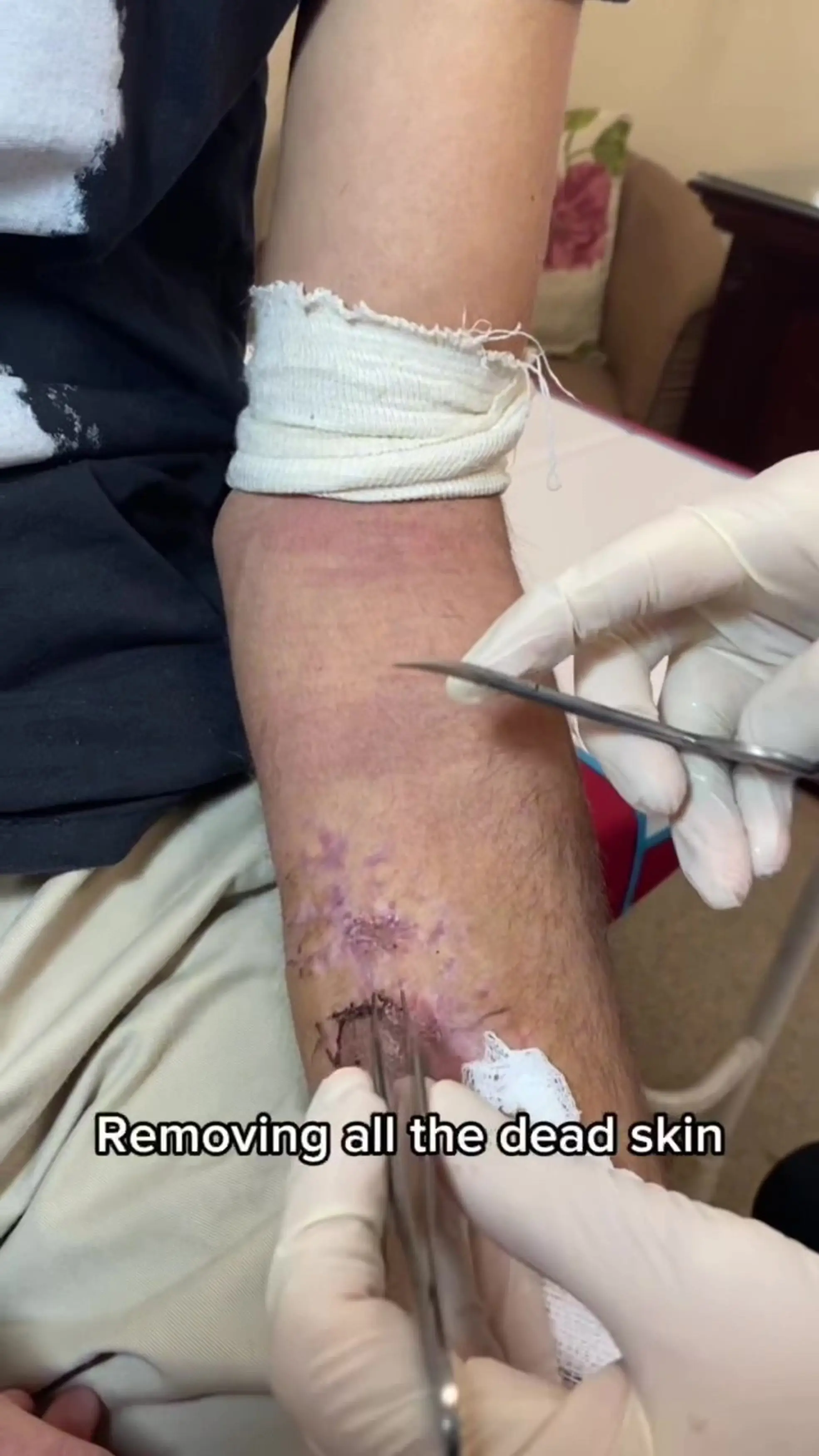 Angus says he might be left with permanent nerve damage in his hand and arm. (Kennedy News and Media)