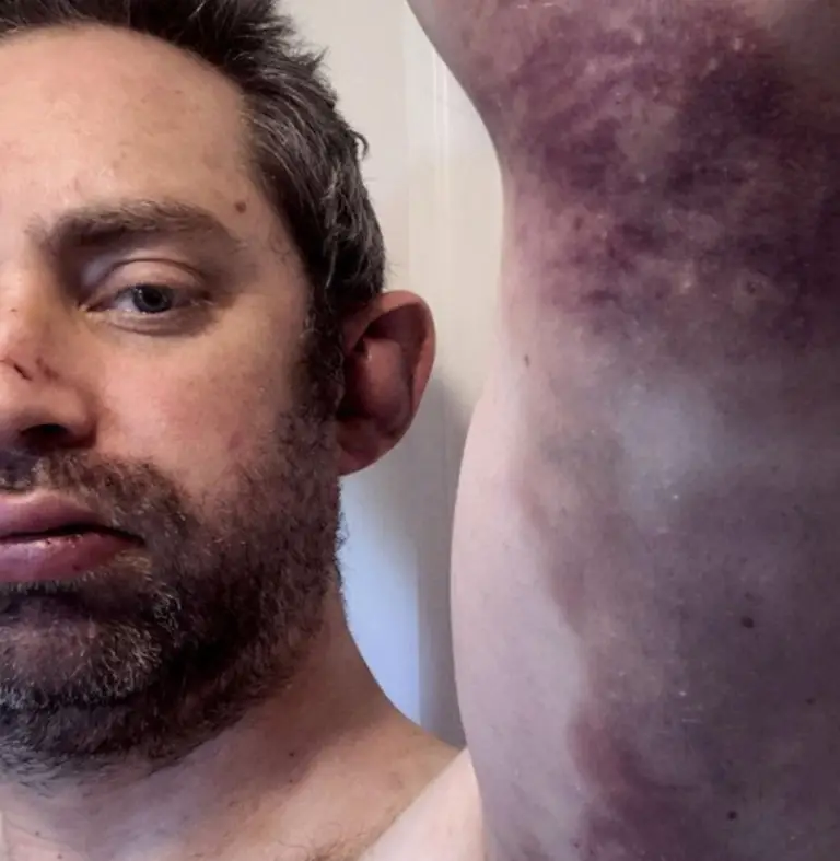 Spencer had horrific injuries from the abuse (Channel 5)