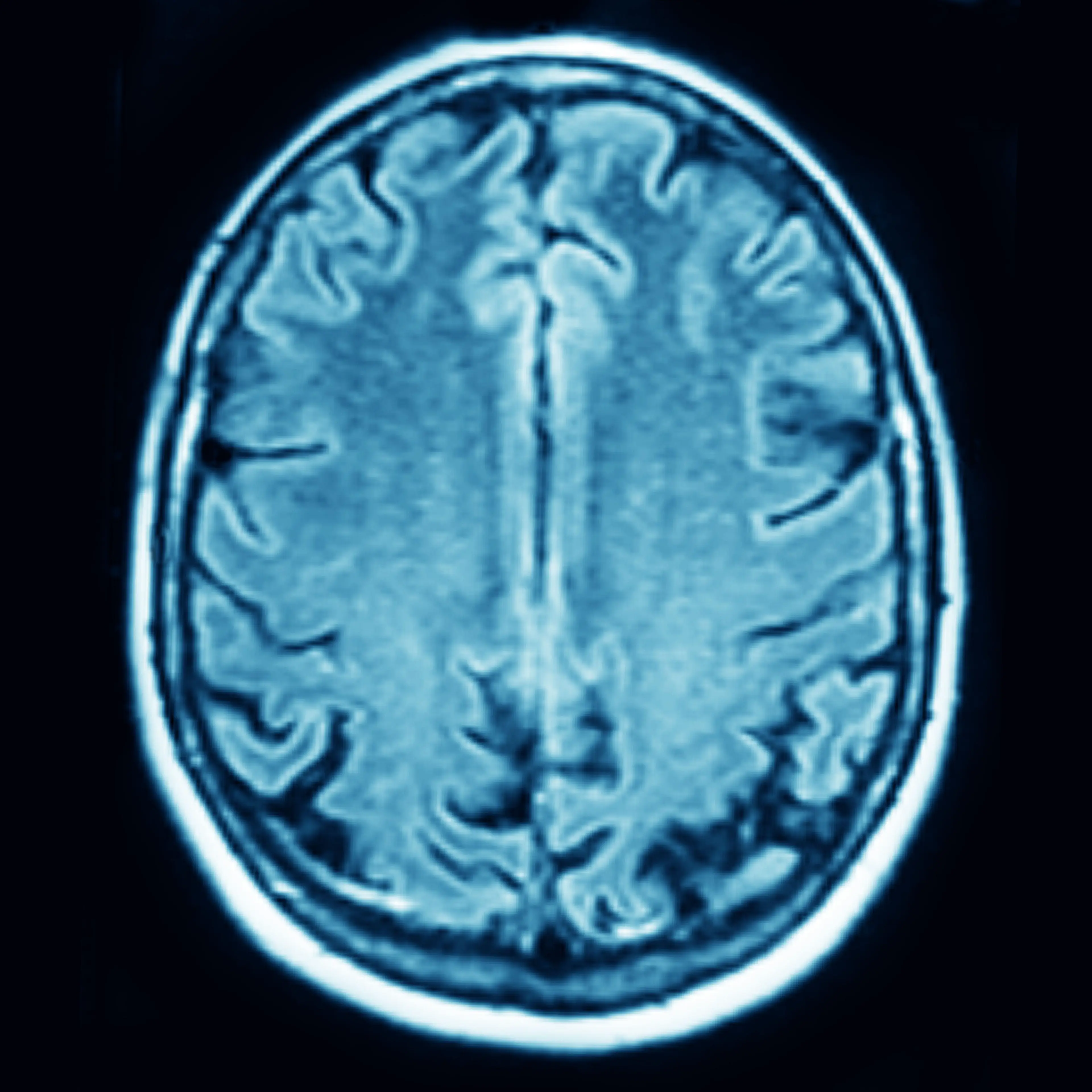 Aphasia impacts the brain's understanding of language (Alamy)