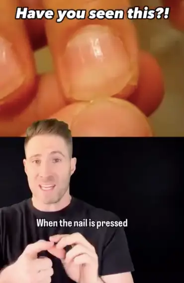 Quincke's sign is 'one of the clues doctors use to help diagnose' aortic regurgitation, says Dr Joe. (Instagram/@drjoe_md)