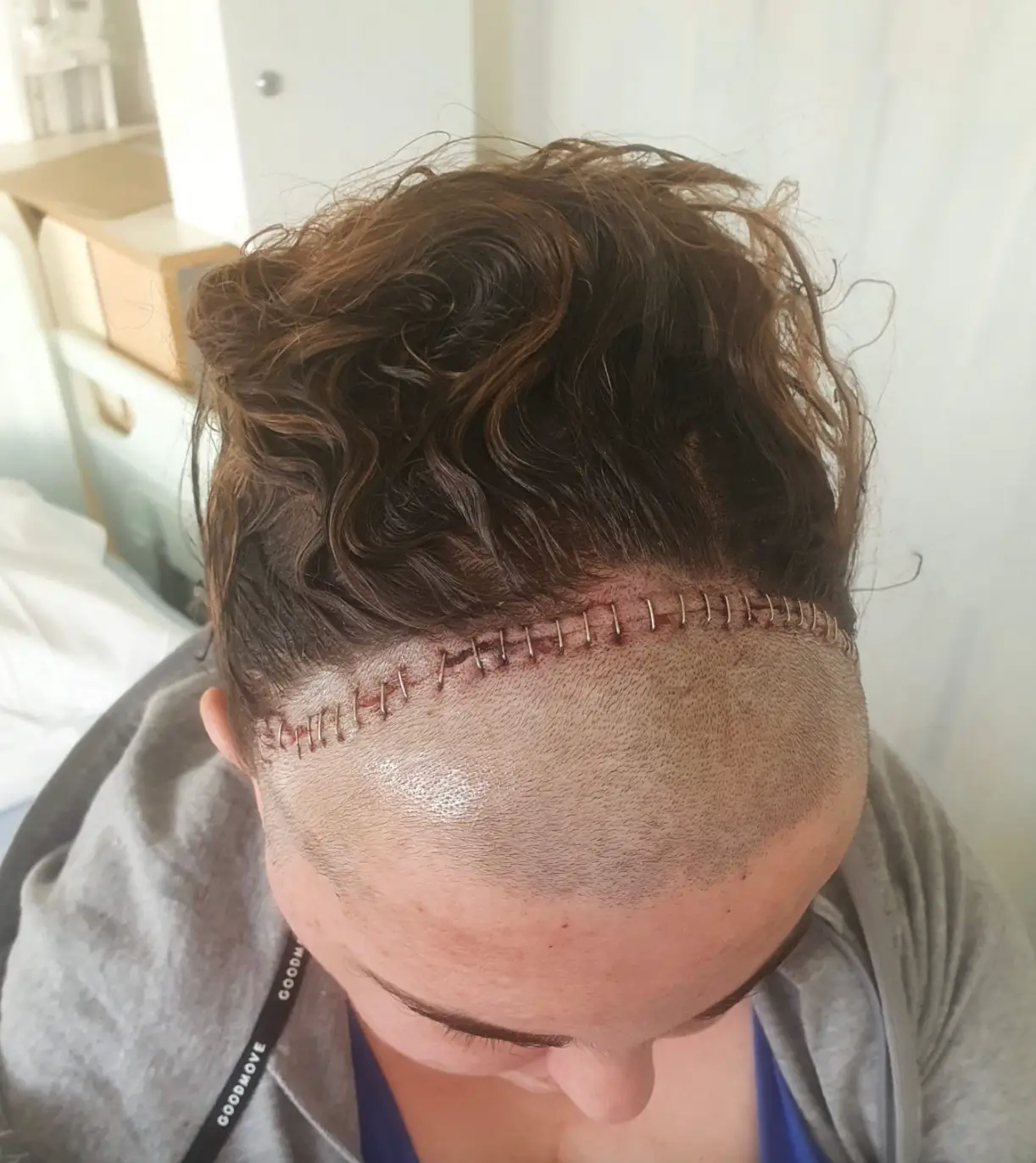 The surgery was lifesaving, but left her with several stitches. (St. George's Hospital)