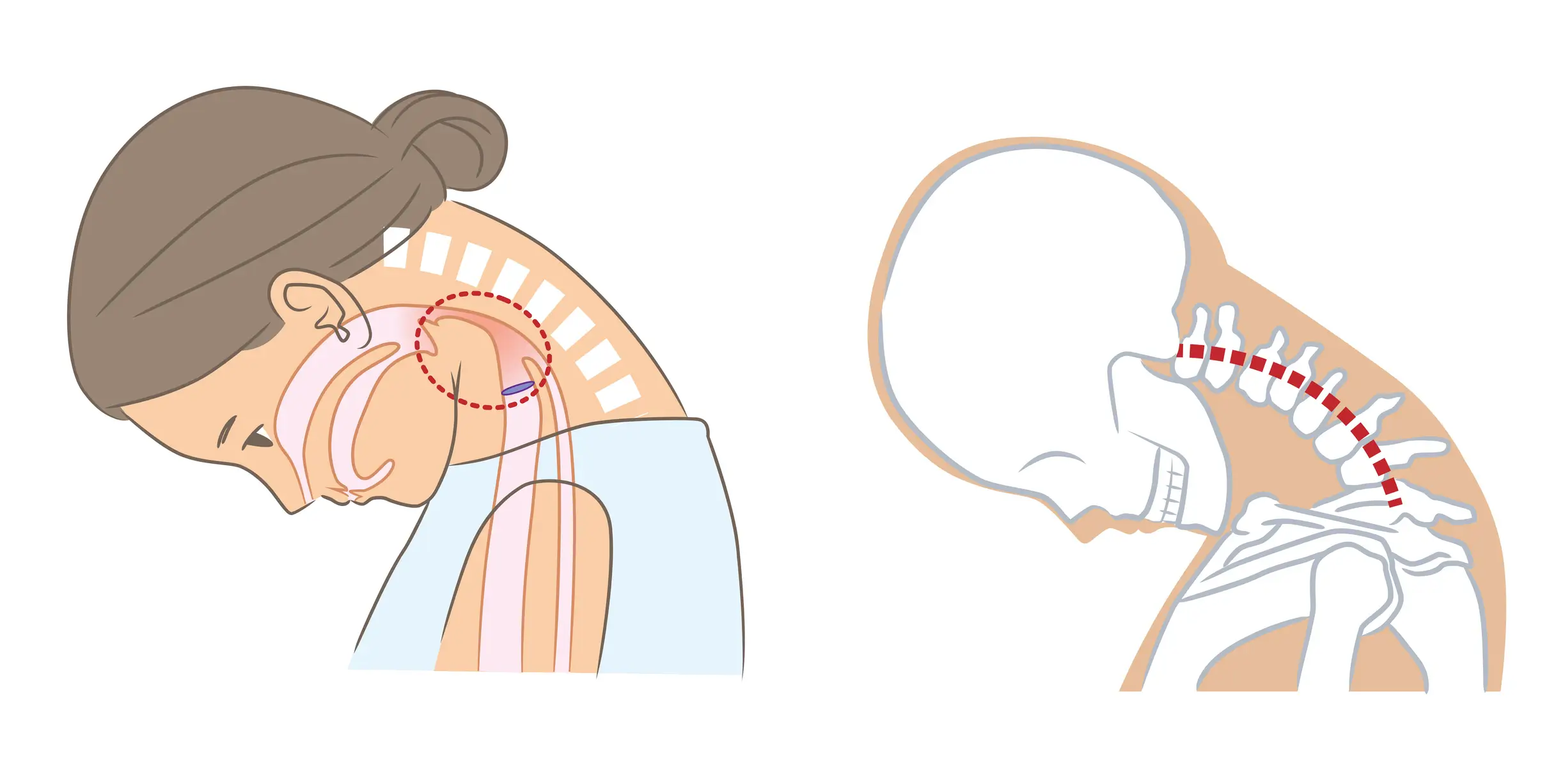 Not being able to put your chin on your chest is a key indicator of meningitis (Getty Stock Images)
