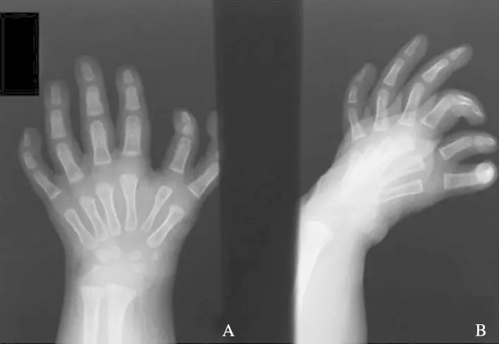Here's an x-ray showing the condition in one child.