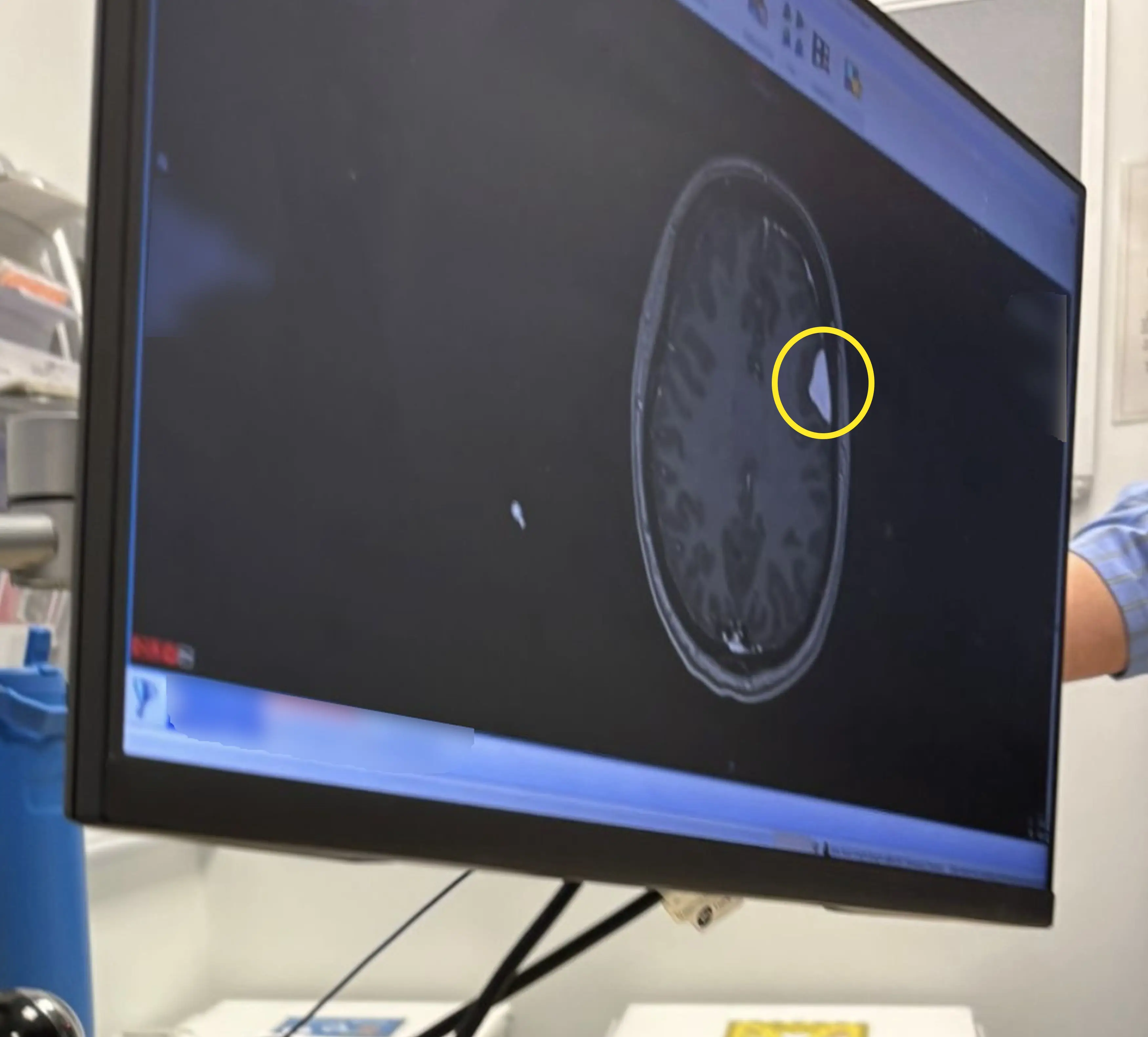 A scan showing the tumours around Kerry's brain (Kennedy News and Media)
