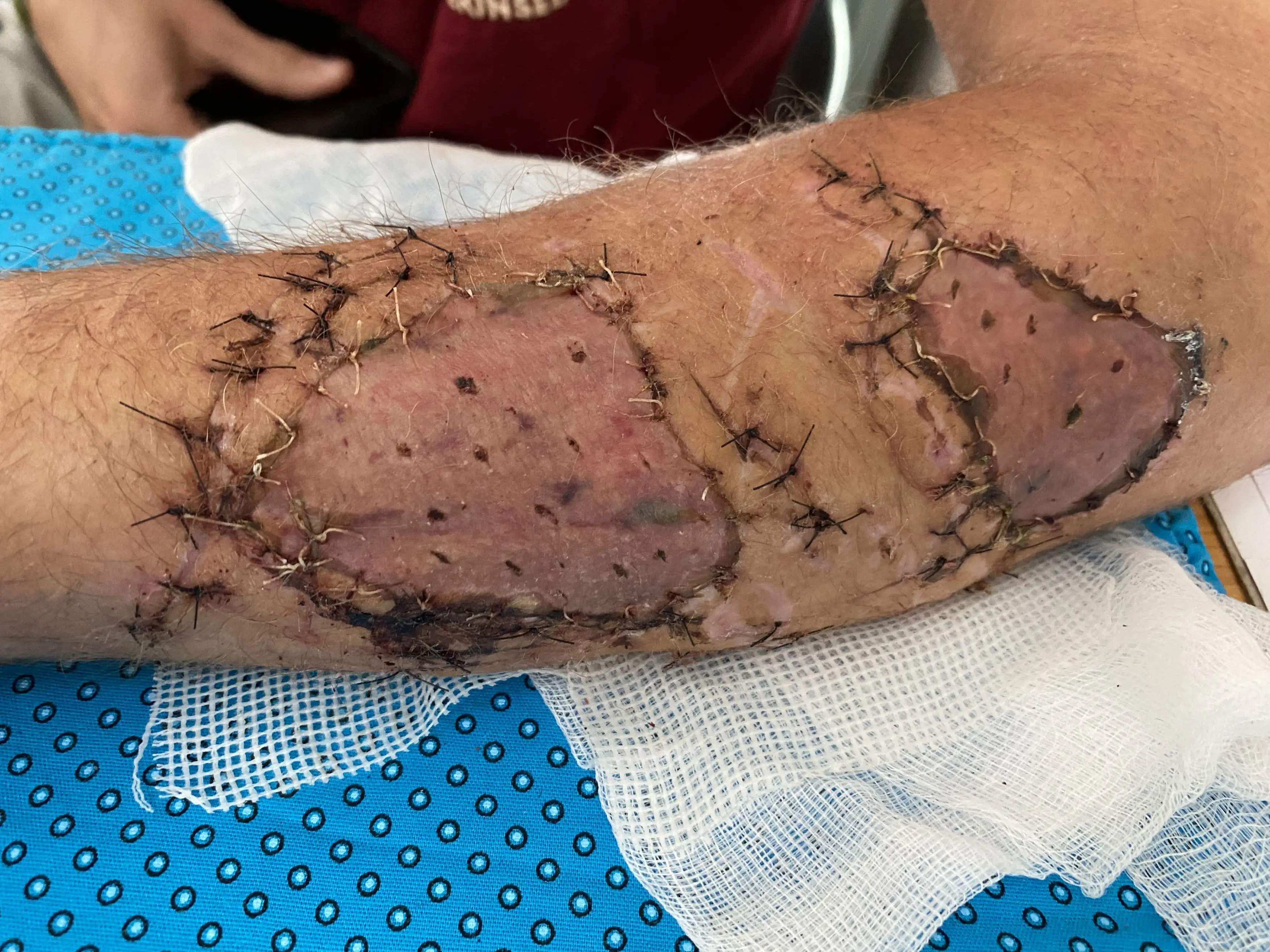 The shark almost took his arm off. (Kennedy News and Media)