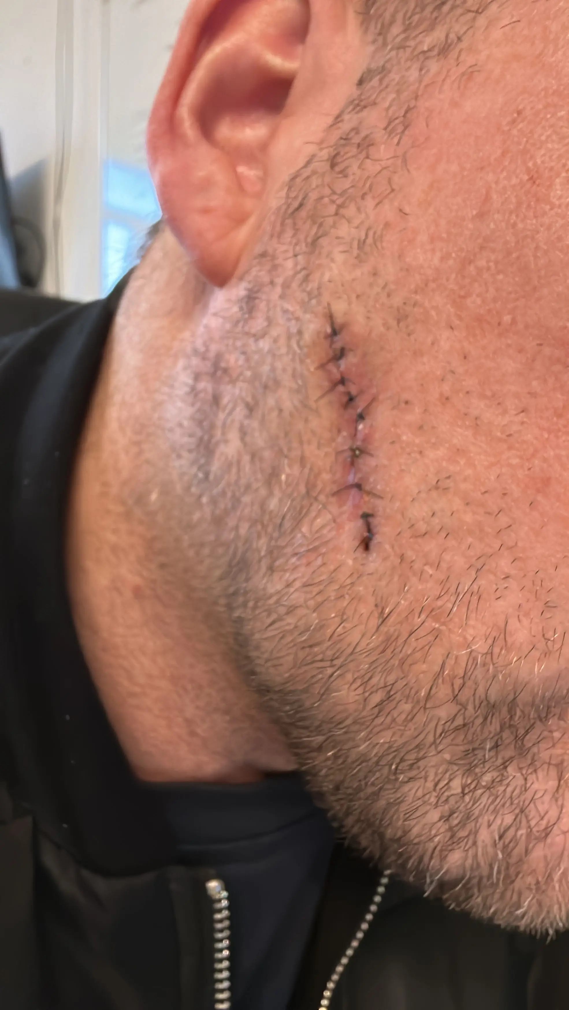 He now has a three inch scar where the growth was (Kennedy News and Media)