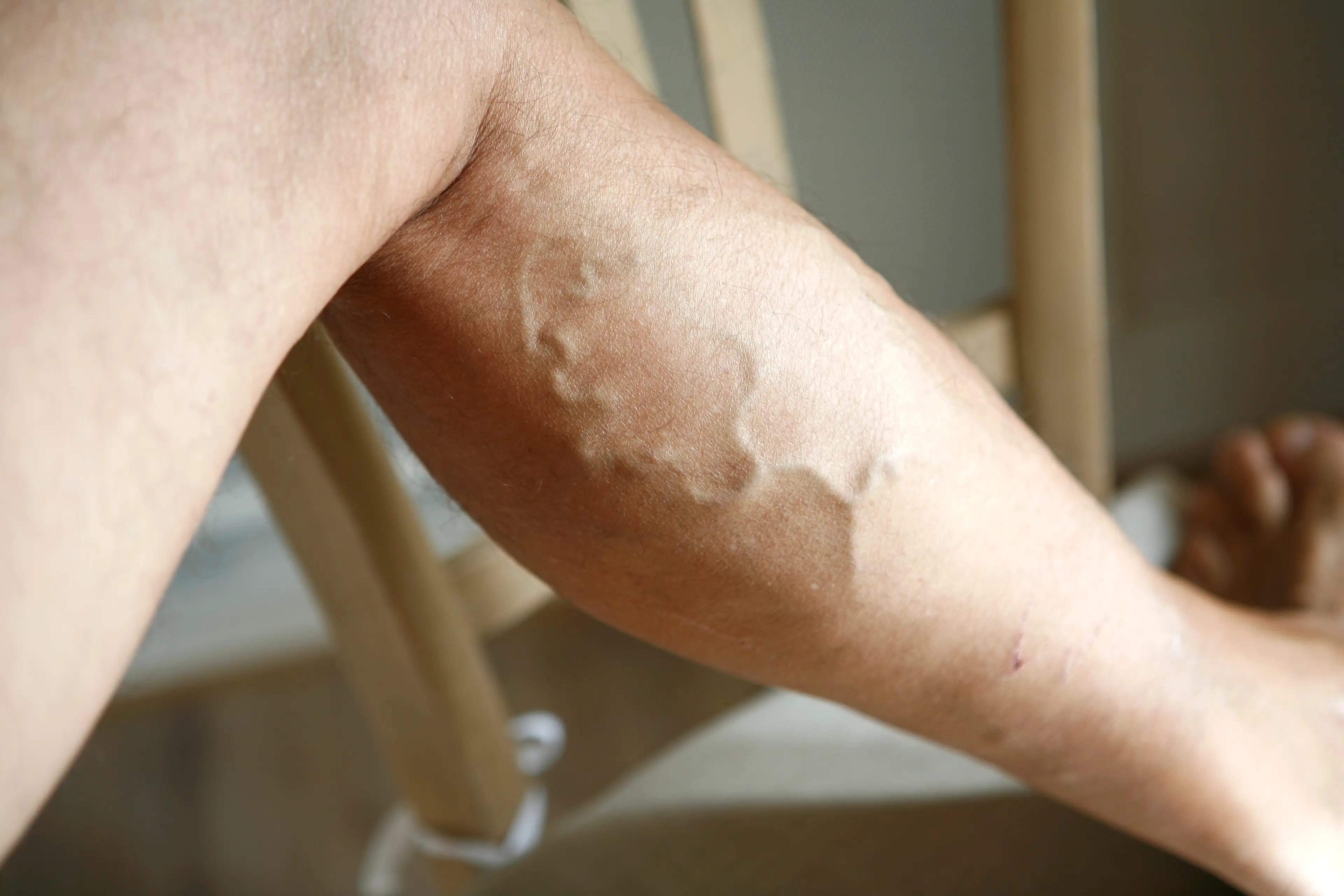 Varicose veins are typically found on the leg, but they can appear elsewhere (BSIP/Universal Images Group via Getty Images)