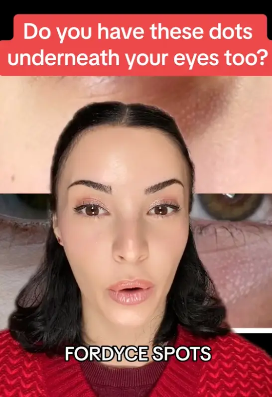 The white bumps are quite common (TikTok/@cheboclinic)