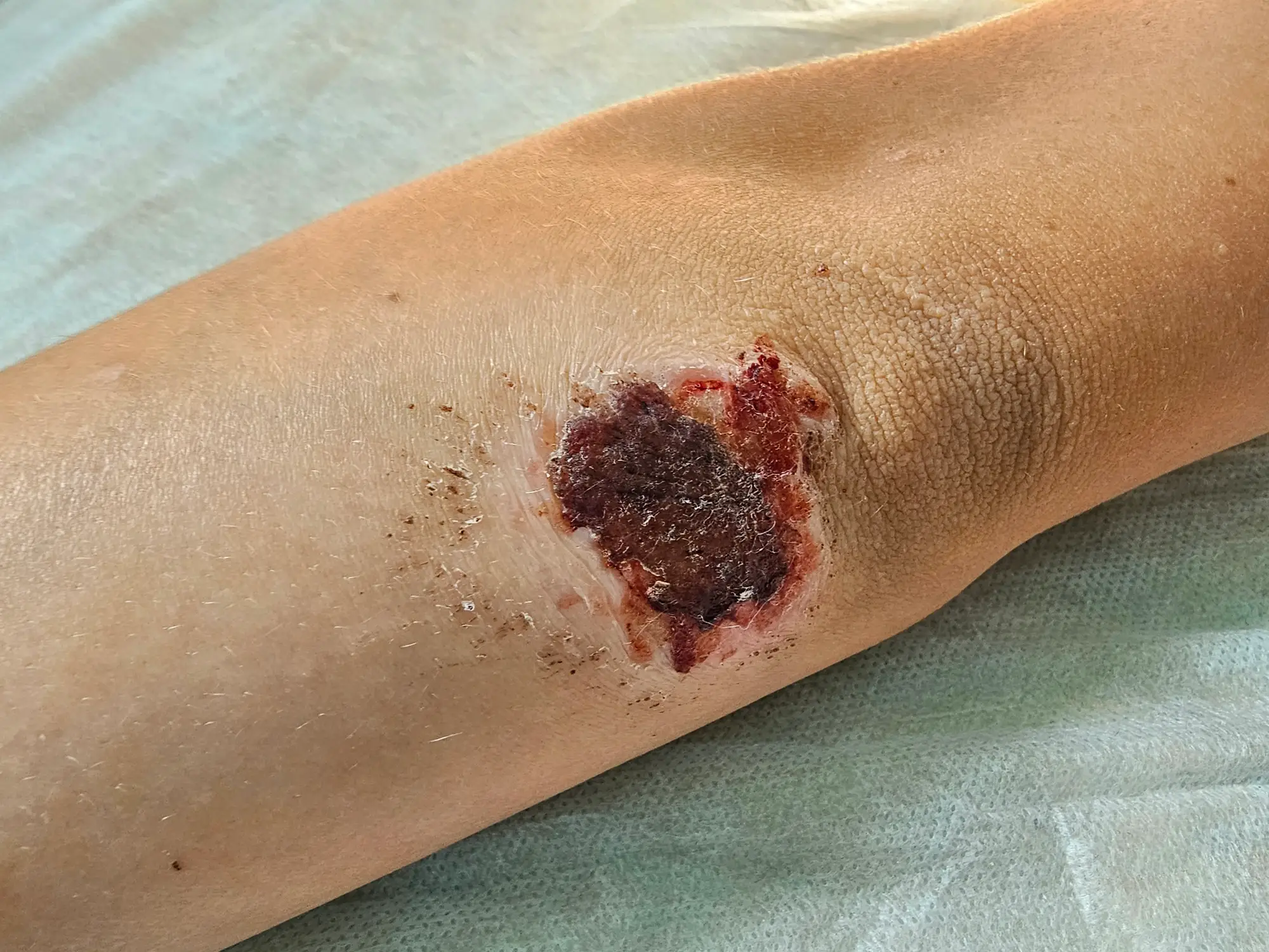 Cuts and wounds are typically how someone gets the illness, but sometimes there's no obvious (Getty Stock Photo)