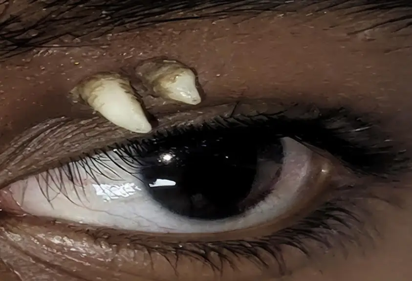 The 16-year-old had a tooth growing in his eye socket (AAO Journal)
