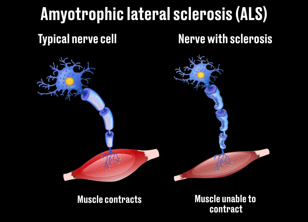 ALS causes the brain to lose connection with the muscles (Getty Stock Image/LADbible)