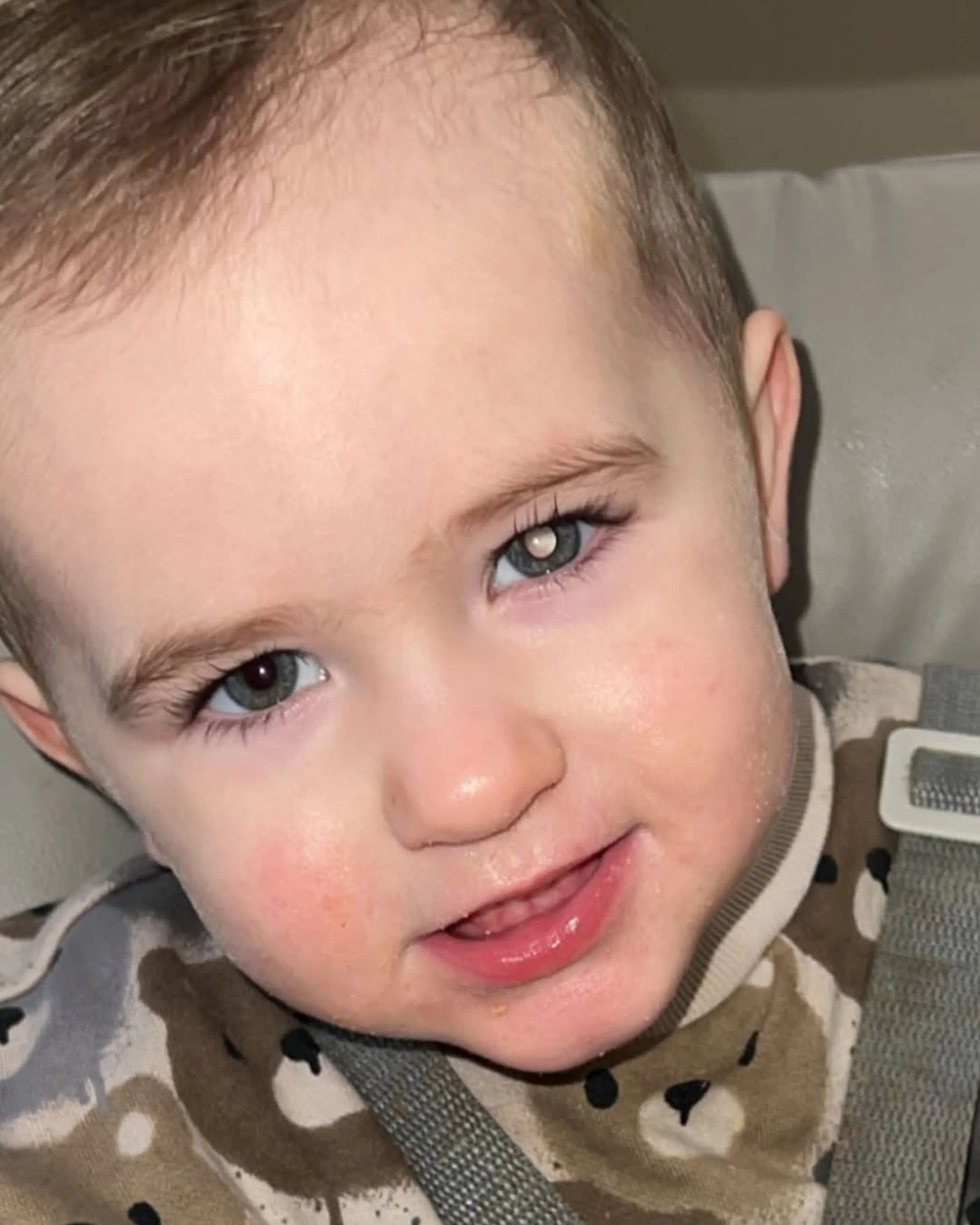 The toddler was diagnosed with unilateral retinoblastoma, a type of eye cancer (Kennedy)