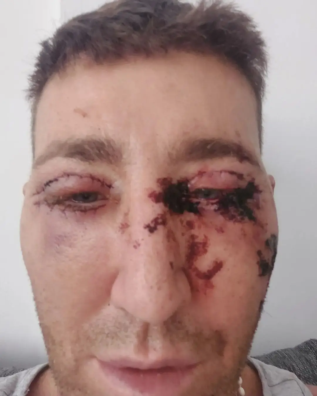 Christopher Maloney shared the results of his eyelid surgery.