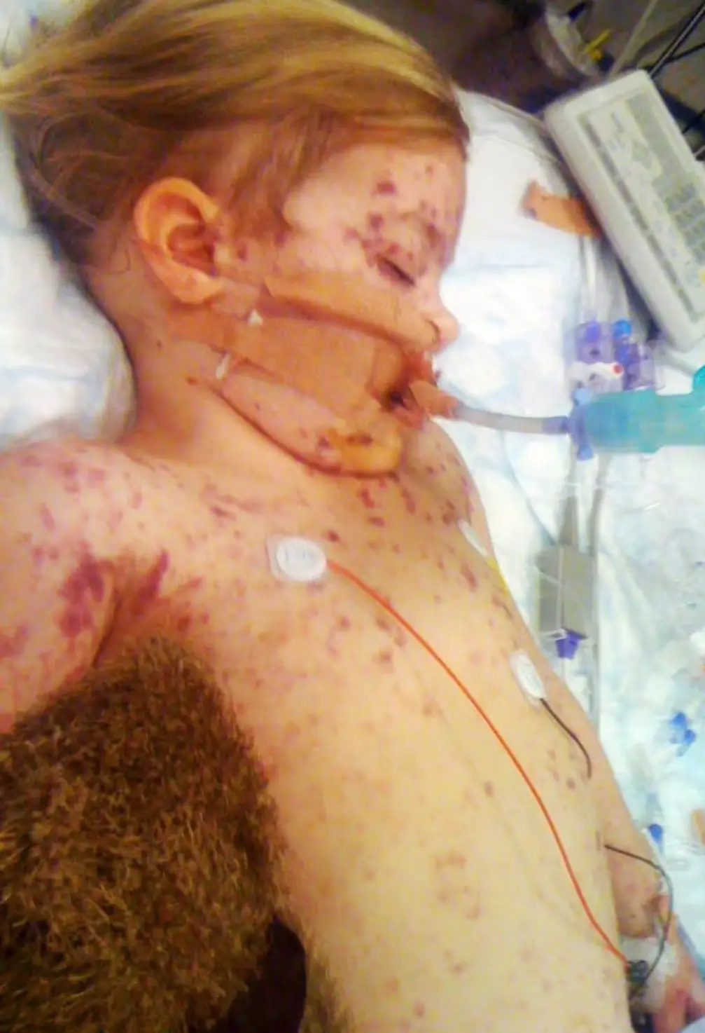 Charlotte woke up covered in a purple rash as a child, after going to bed with a fever (Charlotte Williams)