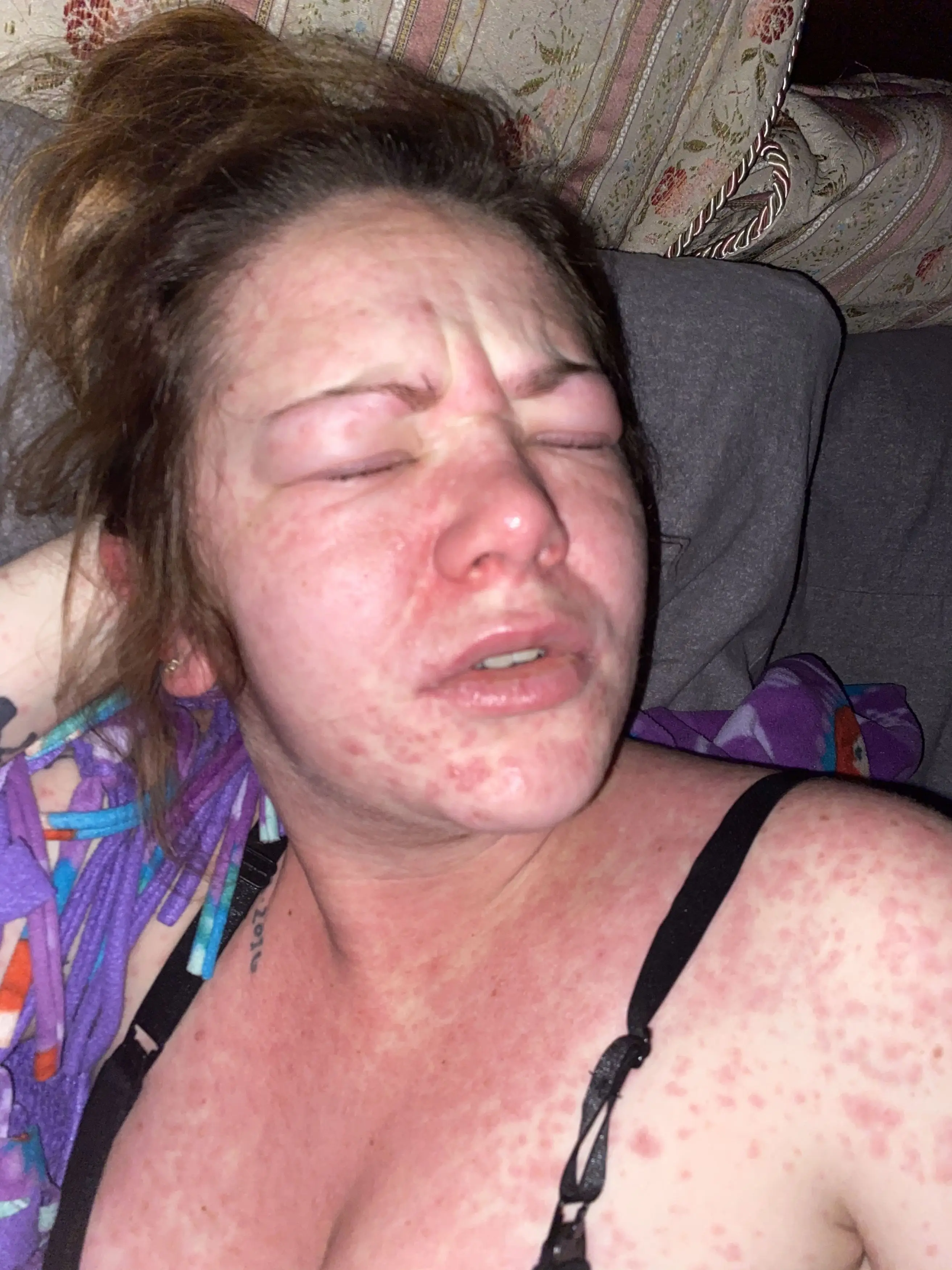 Her face slowly 'burnt away' after an adverse ibuprofen reaction (Kennedy News and Media)