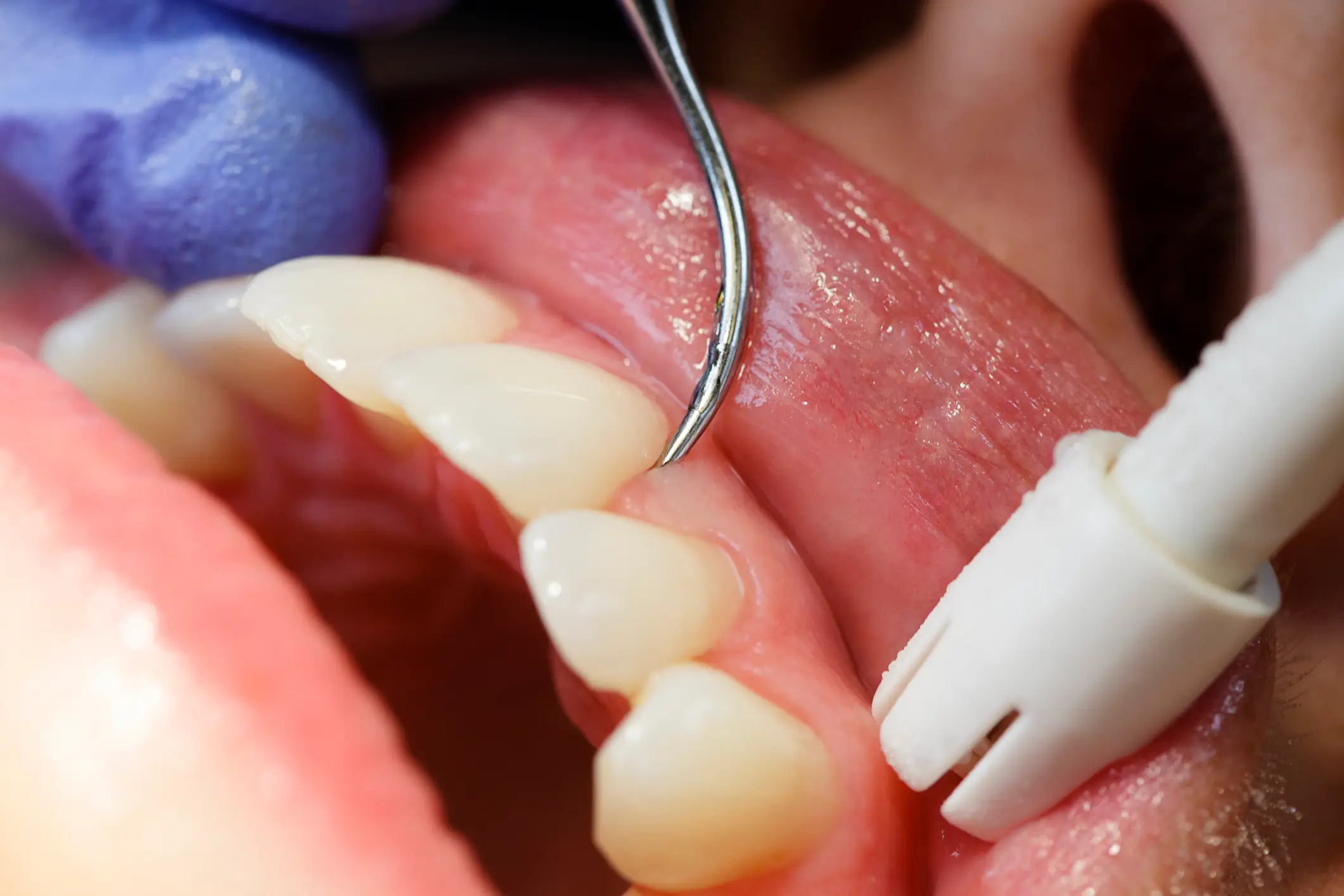 A dentist has spoken about the link between gum disease and other health conditons (Getty Stock Photo)
