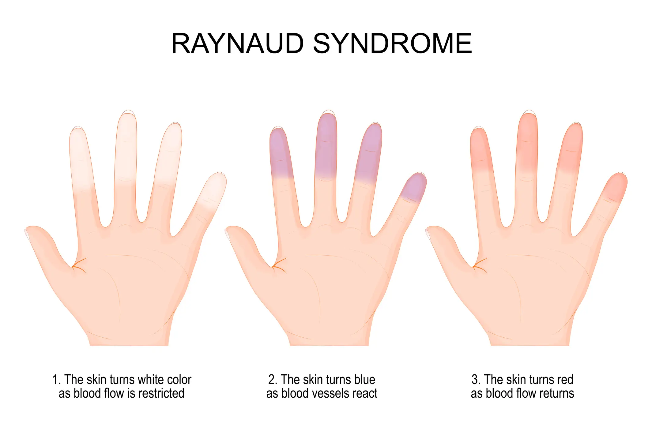 How Raynaud's impacts your body (Getty Stock Images)