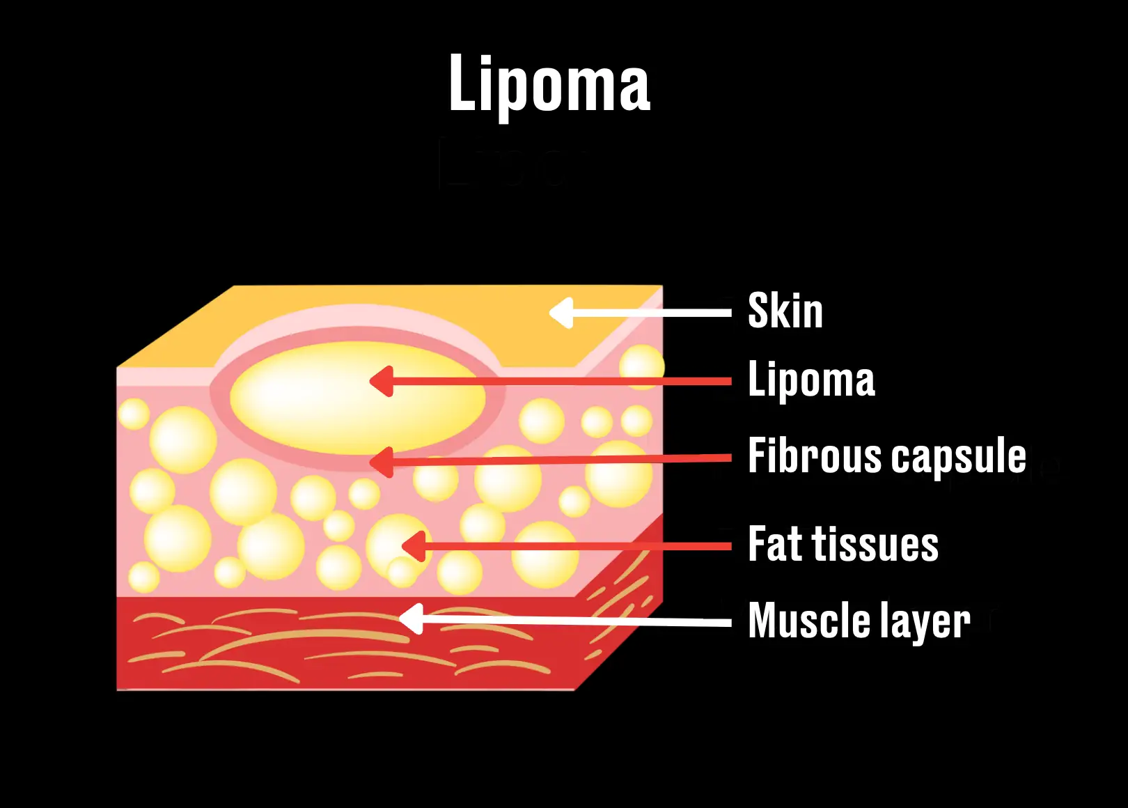 Lipomas are pretty common (Getty Stock Image/LADbible)