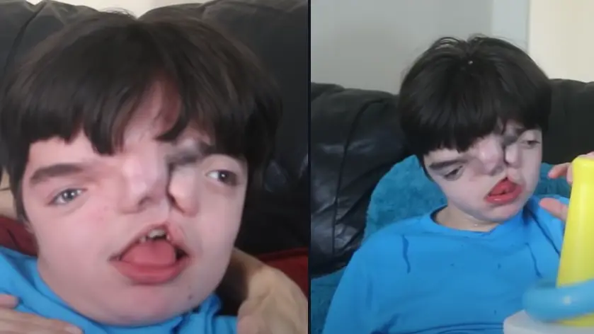 Boy born with 'two faces' because of 'Sonic the Hedgehog' gene