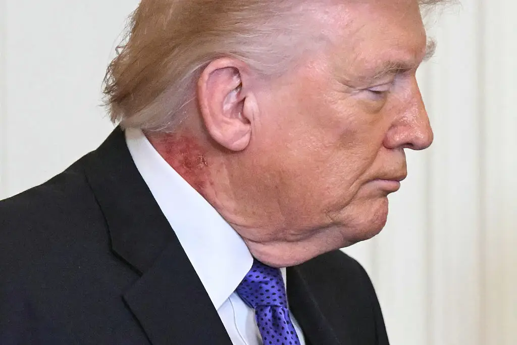 A rash was visible on Trump's neck last month (SAUL LOEB / AFP via Getty Images)