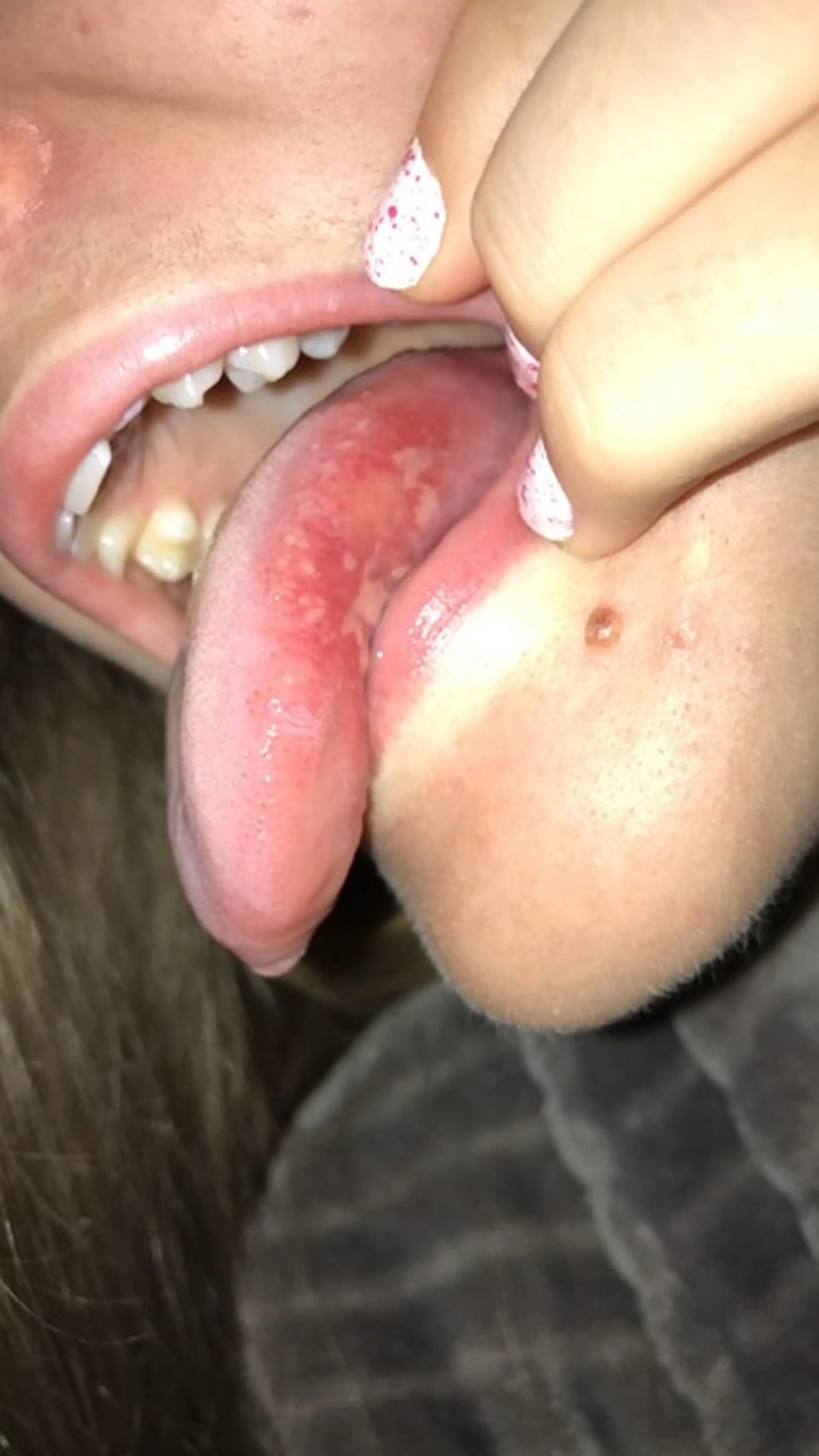 Morton kept getting ulcers.