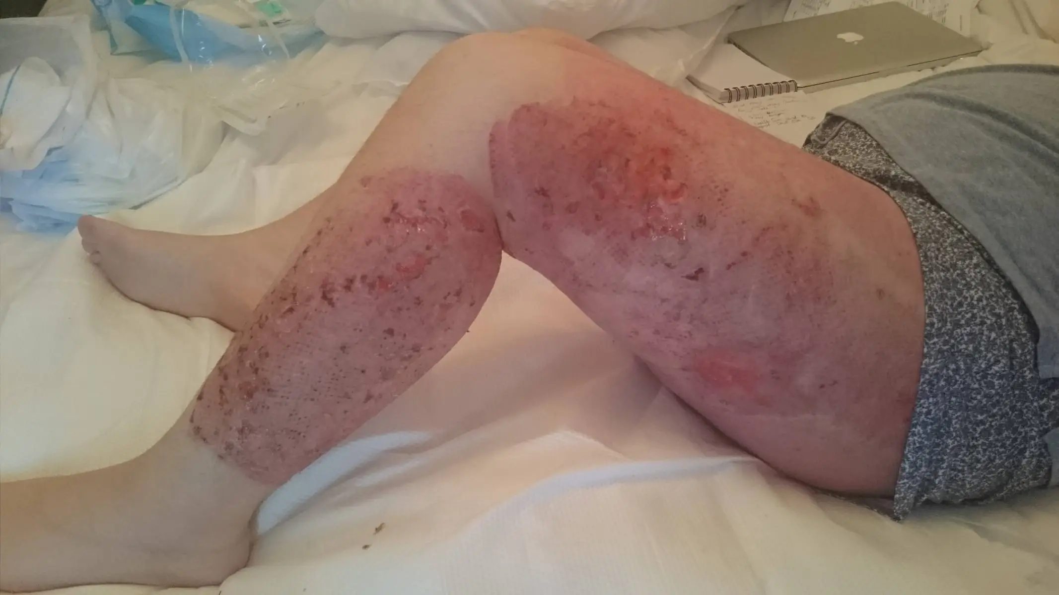 It was a long road to recovery (Rebecca Hay)