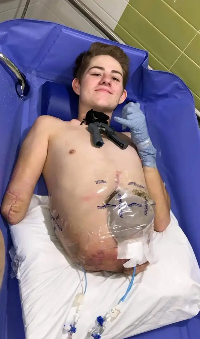 Loren's bodily functions are aided by a colostomy bag.