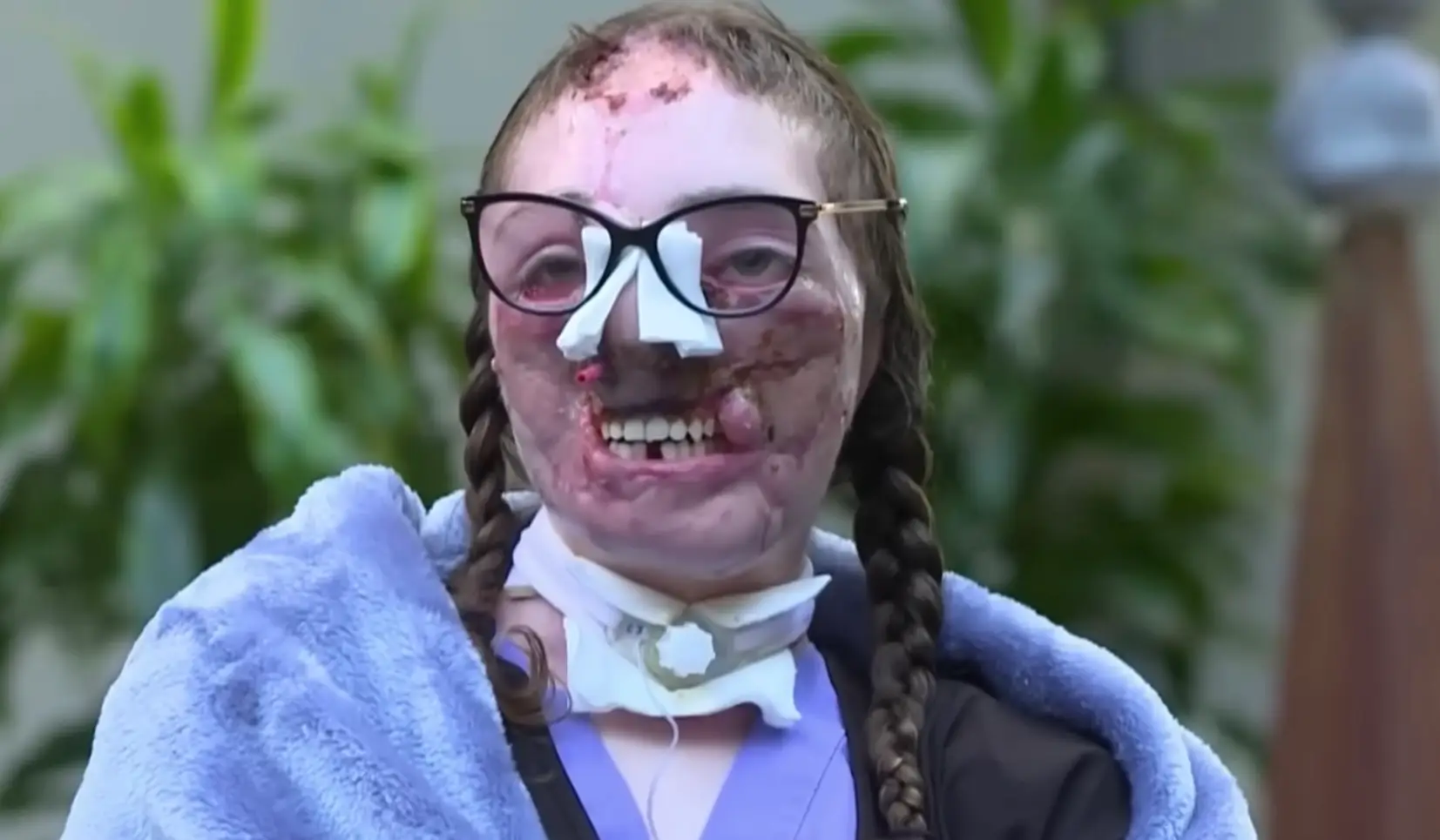 She has undergone 30 surgeries since the horror incident in 2021 (YouTube/CBS Mornings)
