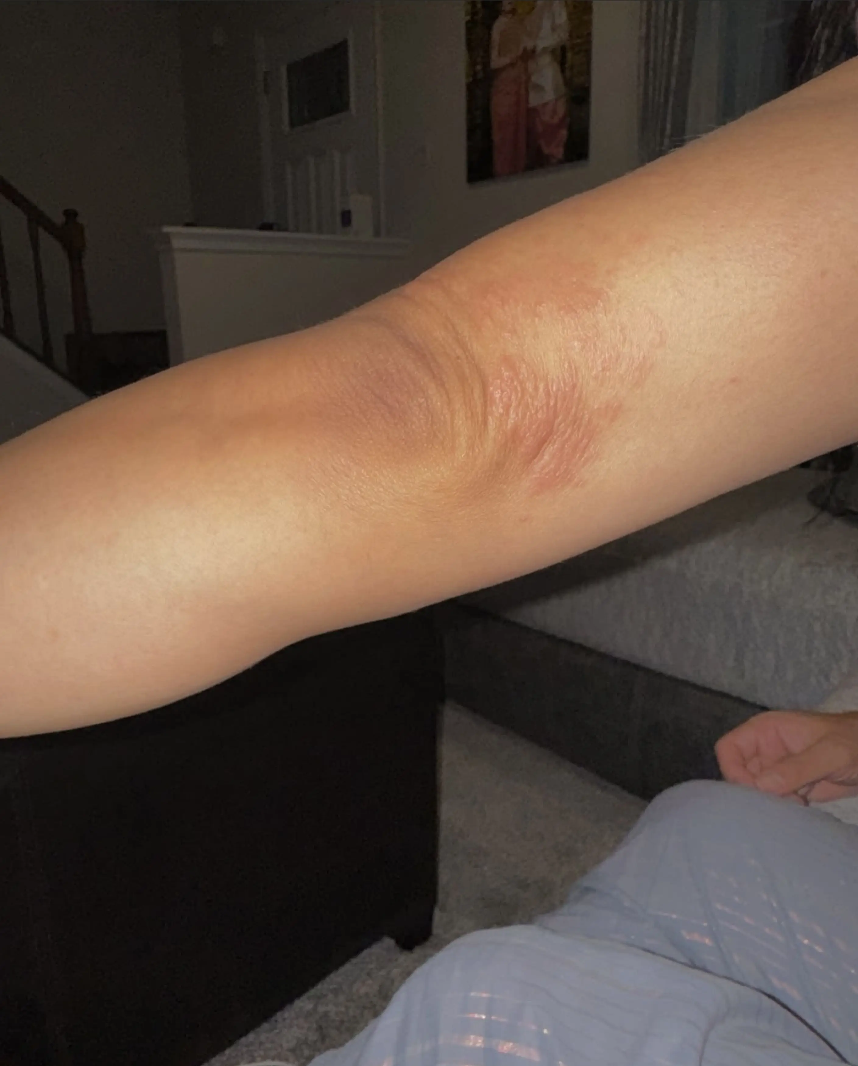 The condition started on her arm, causing her to itch it vigorously (Kennedy News and Media)