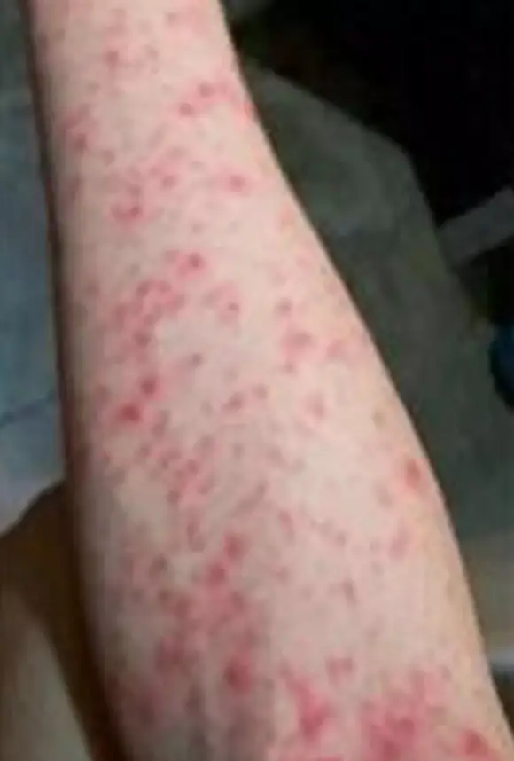 The virus can bring on a rash. (WeChat)