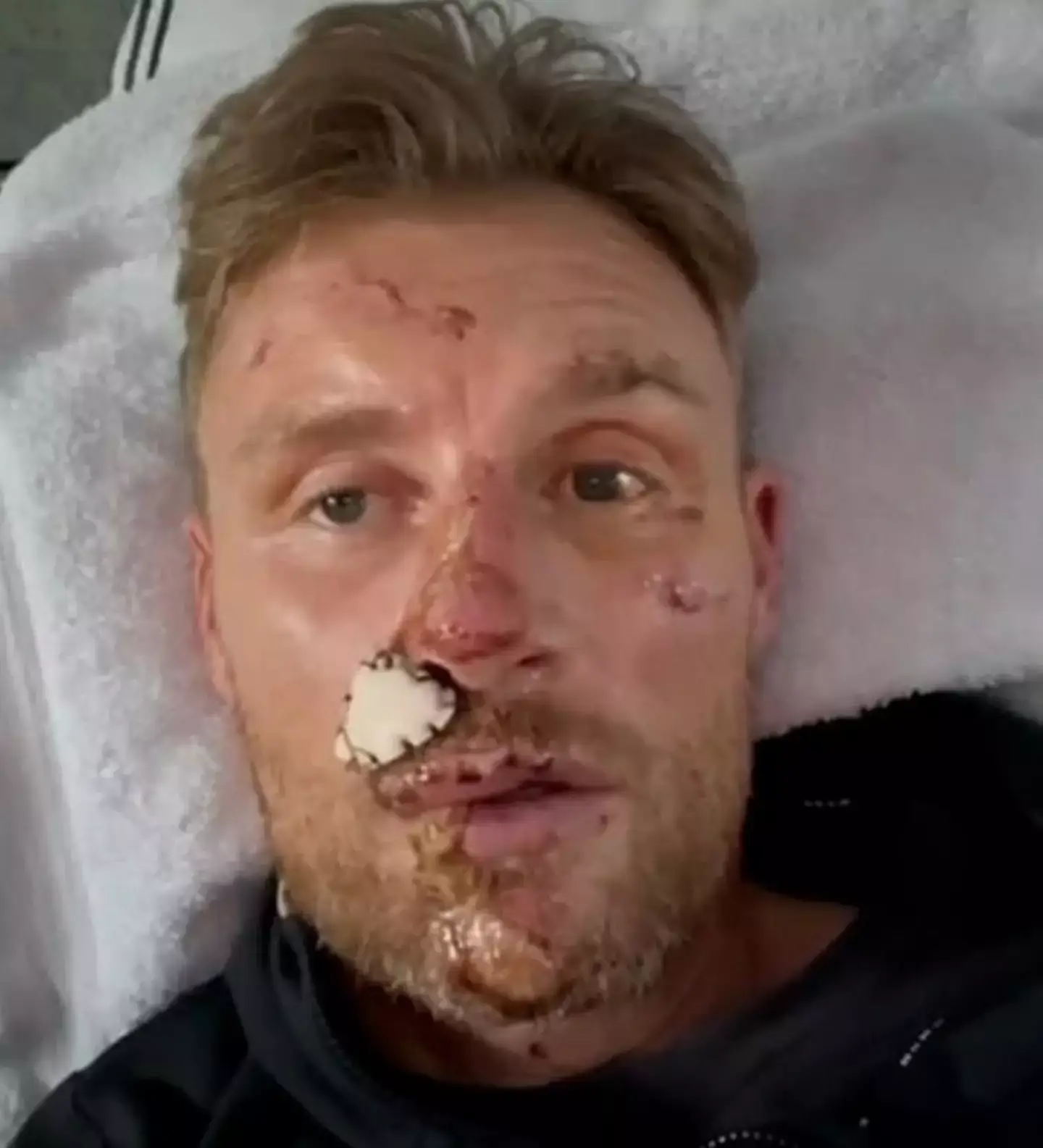Freddie Flintoff's crash left him with broken ribs and facial scarring (BBC)