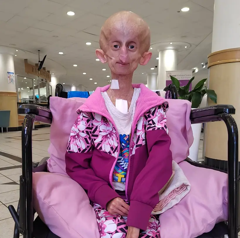 Progeria is a genetic disease which causes children to start aging rapidly, resulting in them having a very low life expectancy. (Beandri Our Inspiration/Facebook)