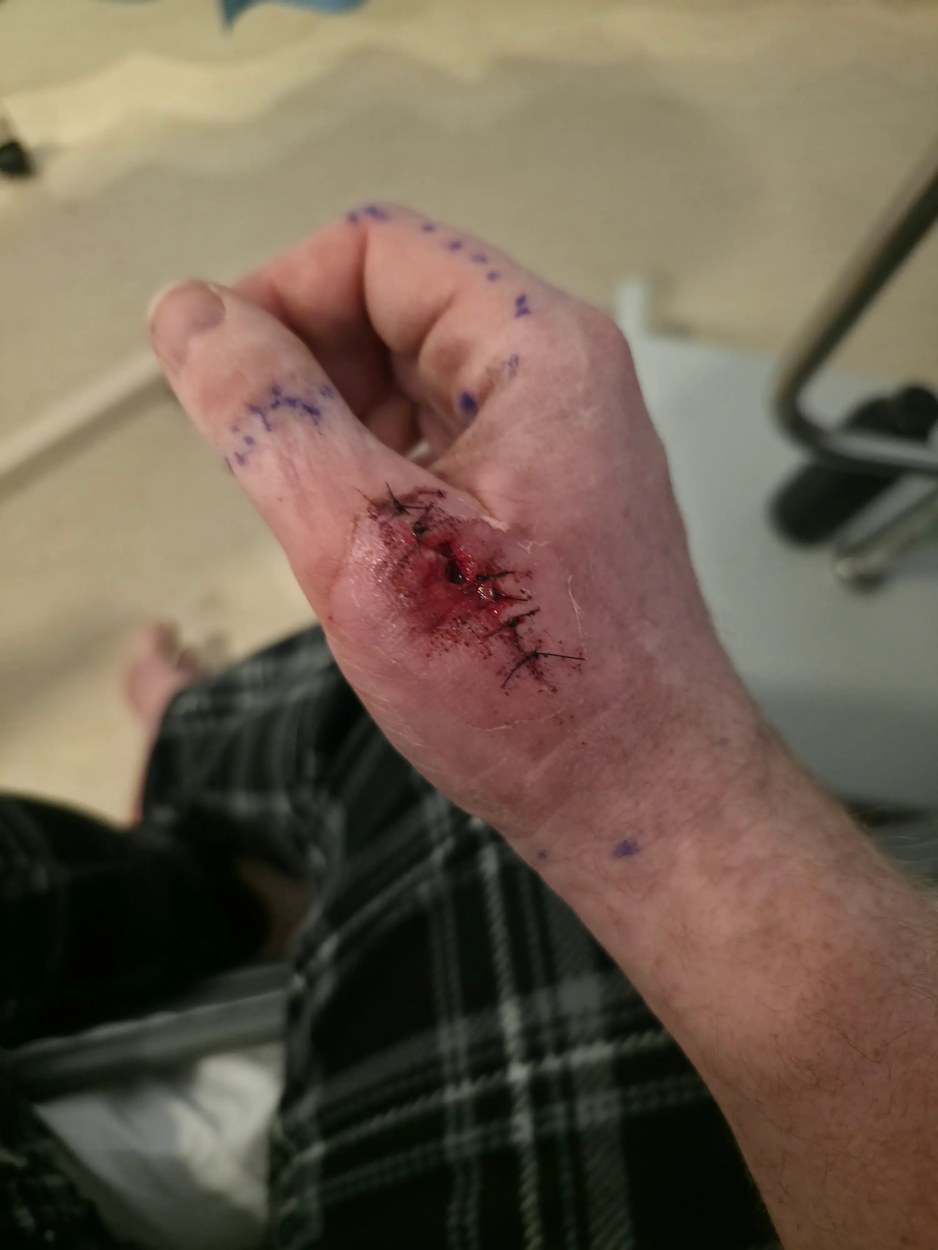 He had multiple surgeries before being allowed to return home (SWNS)