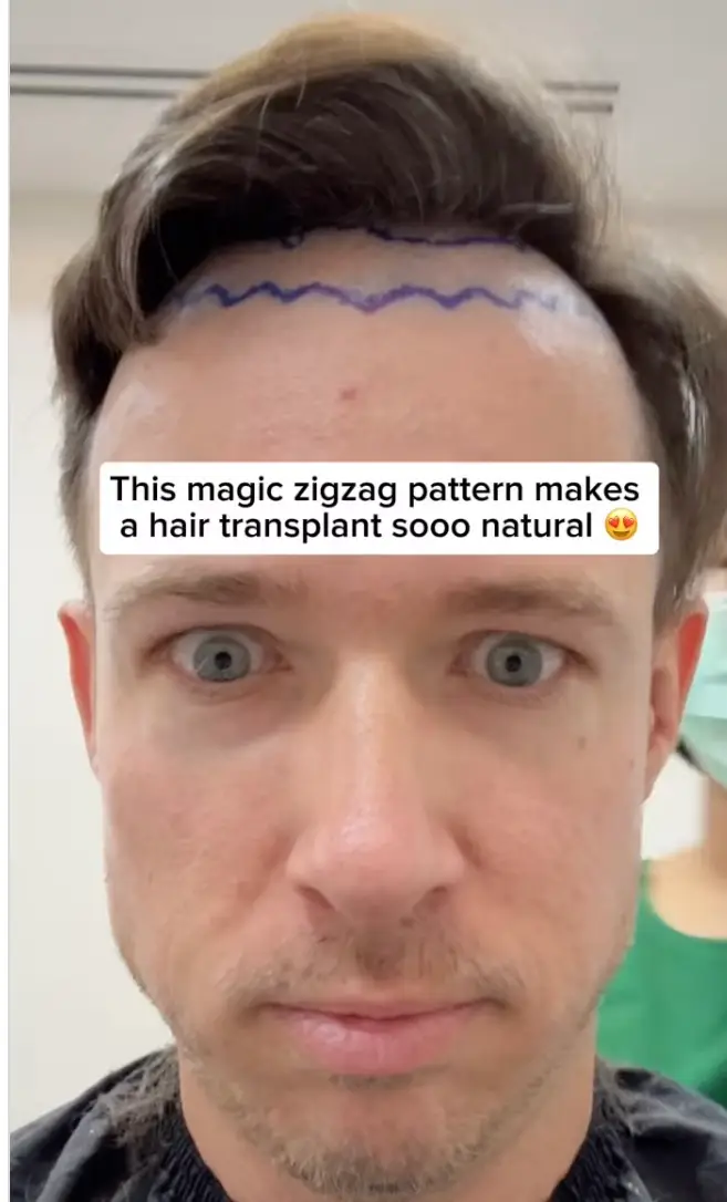 The bloke opted for a 'zig zag' hairline when undergoing a hair transplant (Instagram/@mrhairline1)