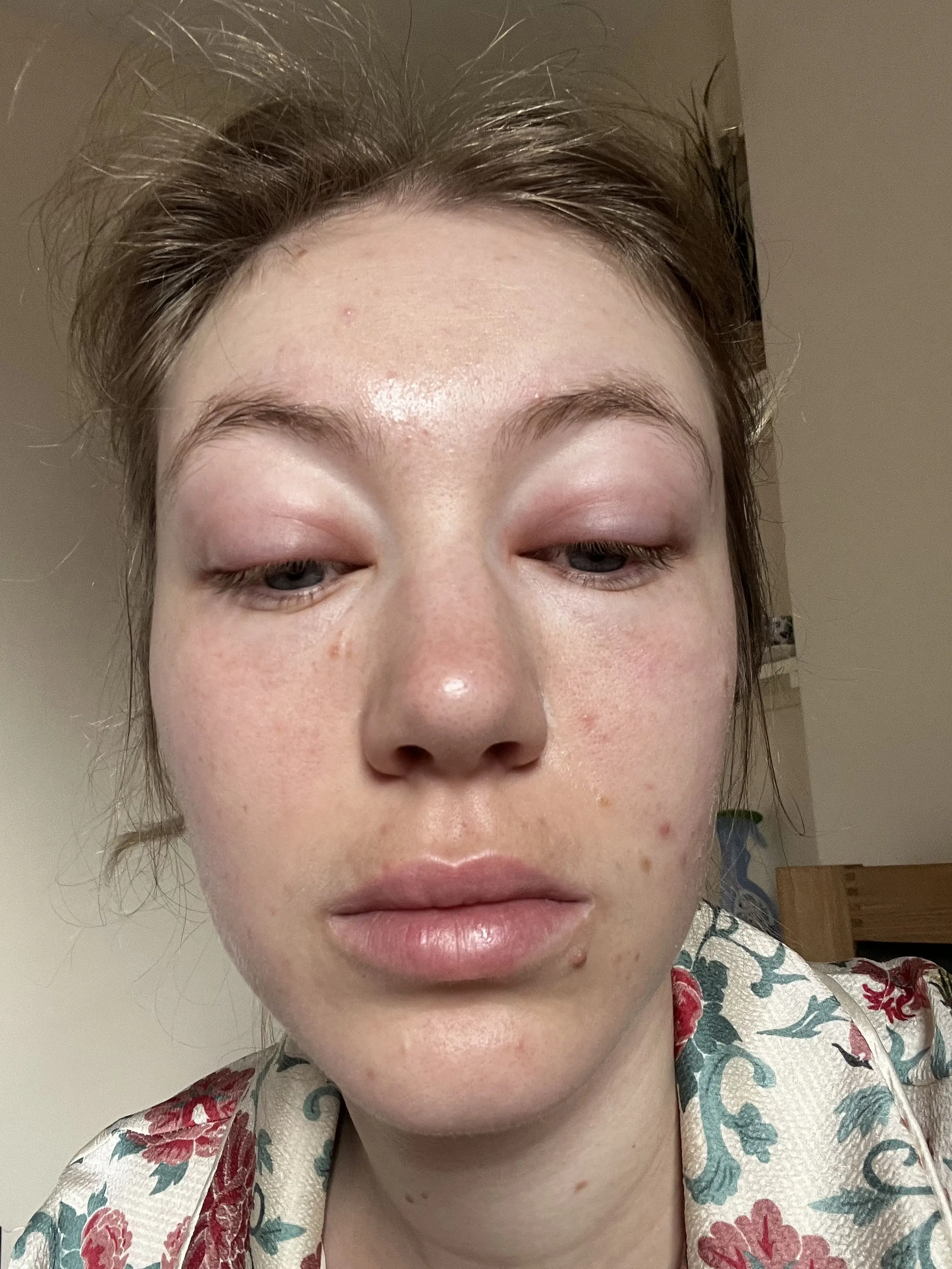 Ellen was often waking up with a swollen face. (Kennedy News and Media)