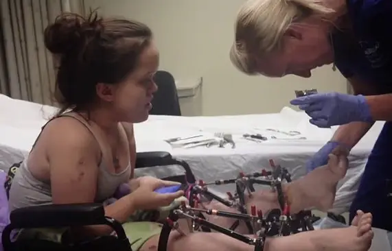 Chandler is an advocate for limb lengthening (Facebook)