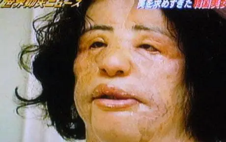 Hang Mioku has been left swollen and disfigured by the procedures (SBS)