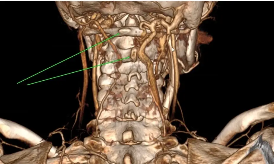 The Michigan mum's health woes are down to hEDS (GoFundMe)