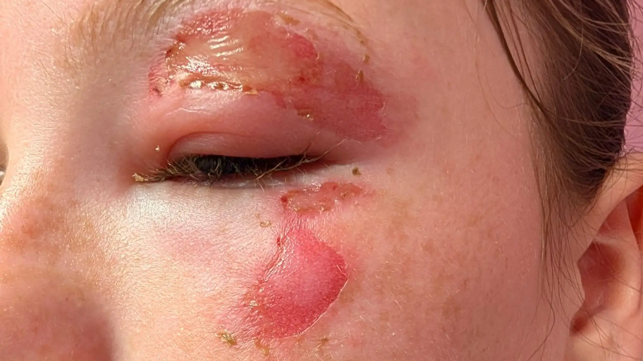 One young girl sustained burns to her eyelid and face (NHSGGC)