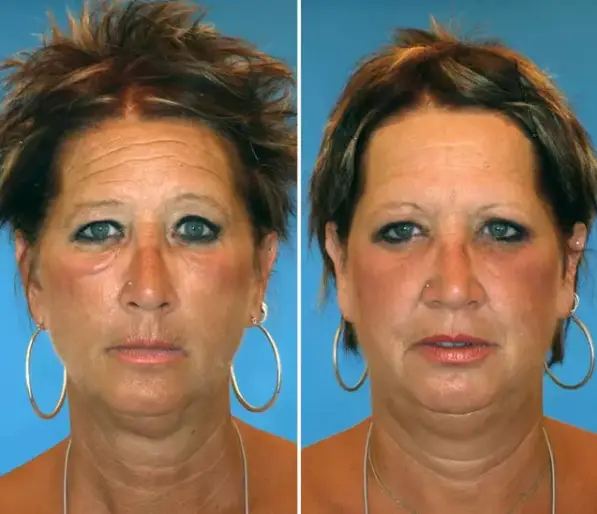 "The festoons of loose skin' under Brenda’s (left) eyes are down to her smoking habit," Dr Guyuron said (NBC)