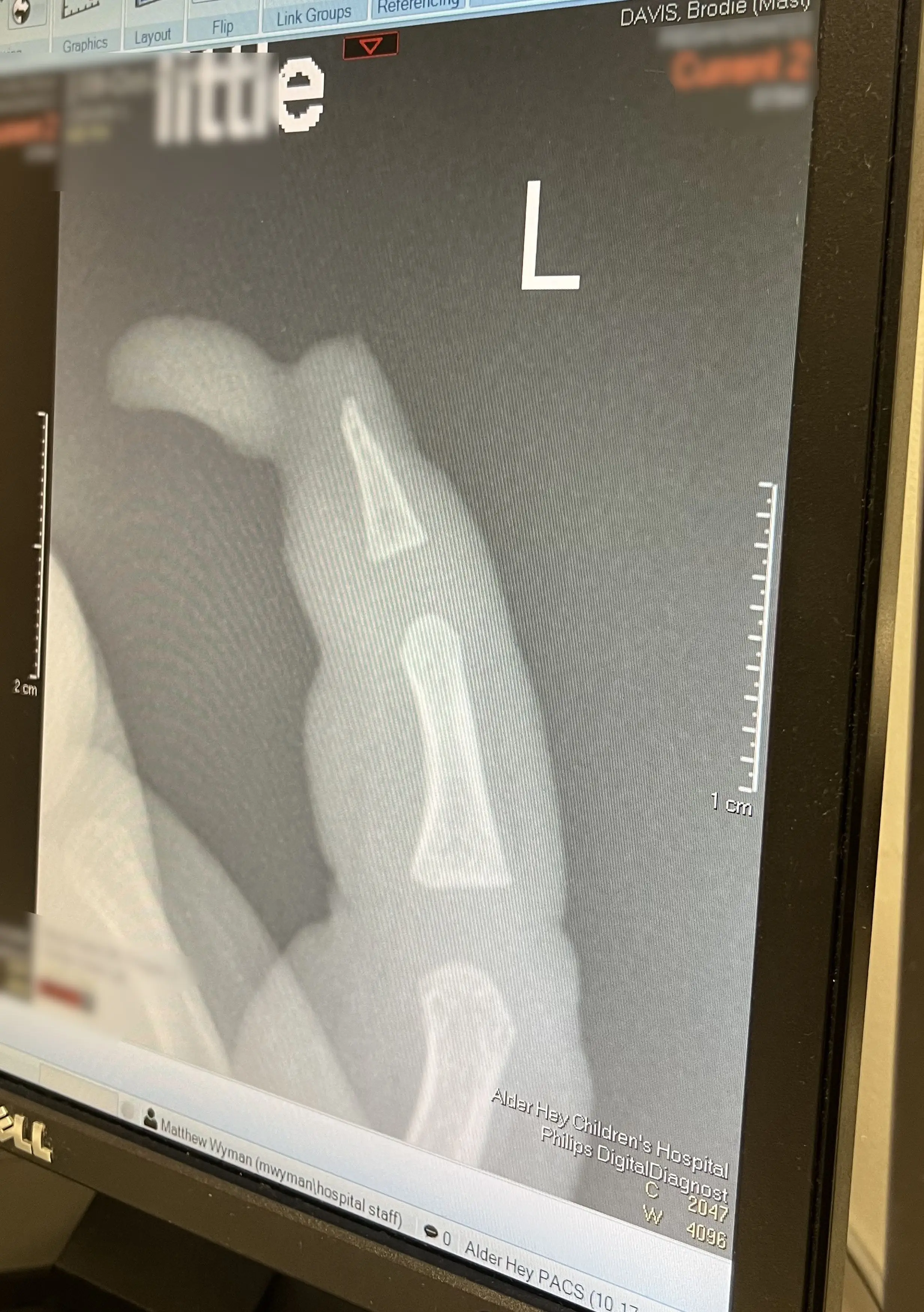 The tip of the toddler's finger had to be surgically reattached, and he may need a skin graft in the future. (Kennedy News and Media)