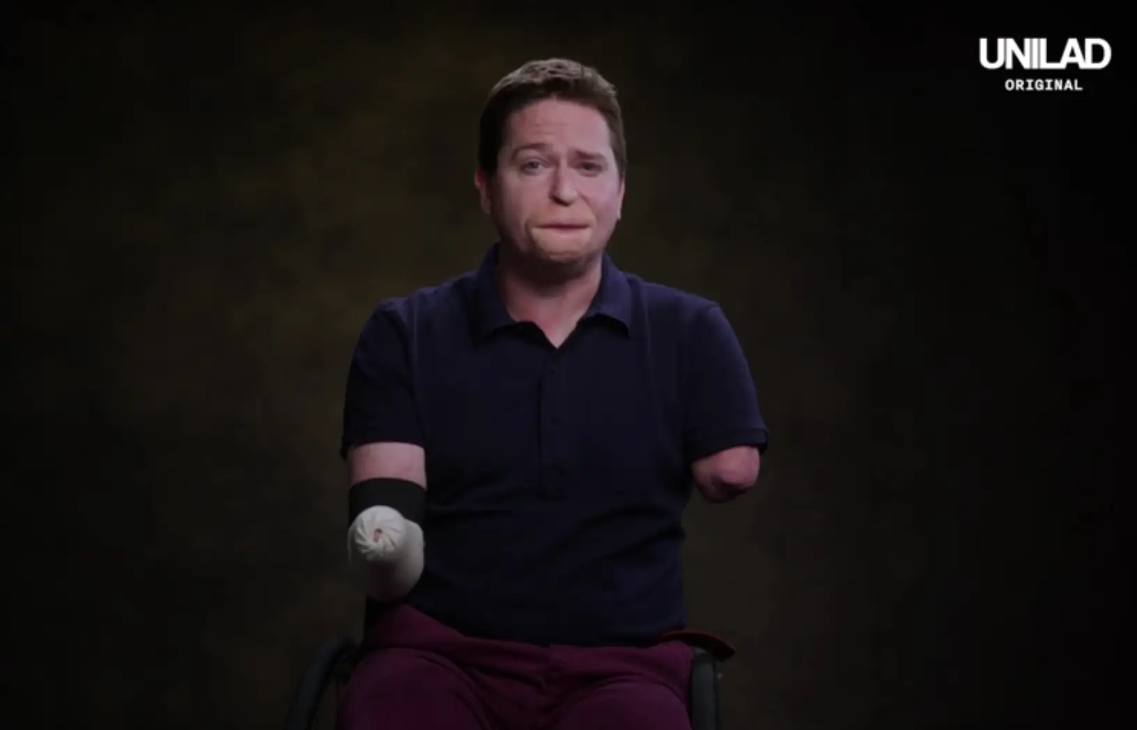 A Brit who thought he had ‘man flu’ ended up losing his limbs and a portion of his face to Strep A.