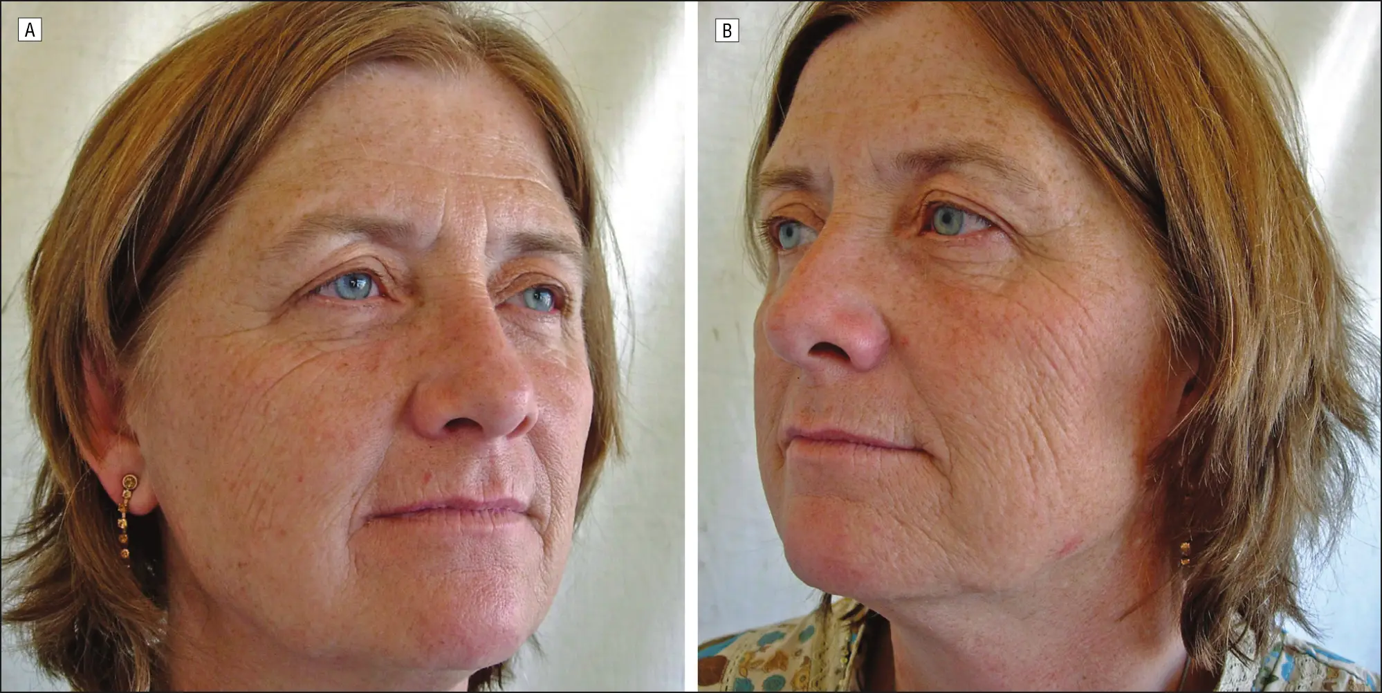 Twin 1 was the smoker. (Arch Dermatol/JAMA Dermatology)