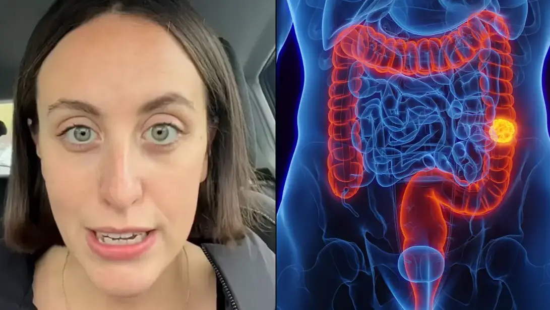 Woman diagnosed with bowel cancer aged 25 reveals unusual symptom all young people should know