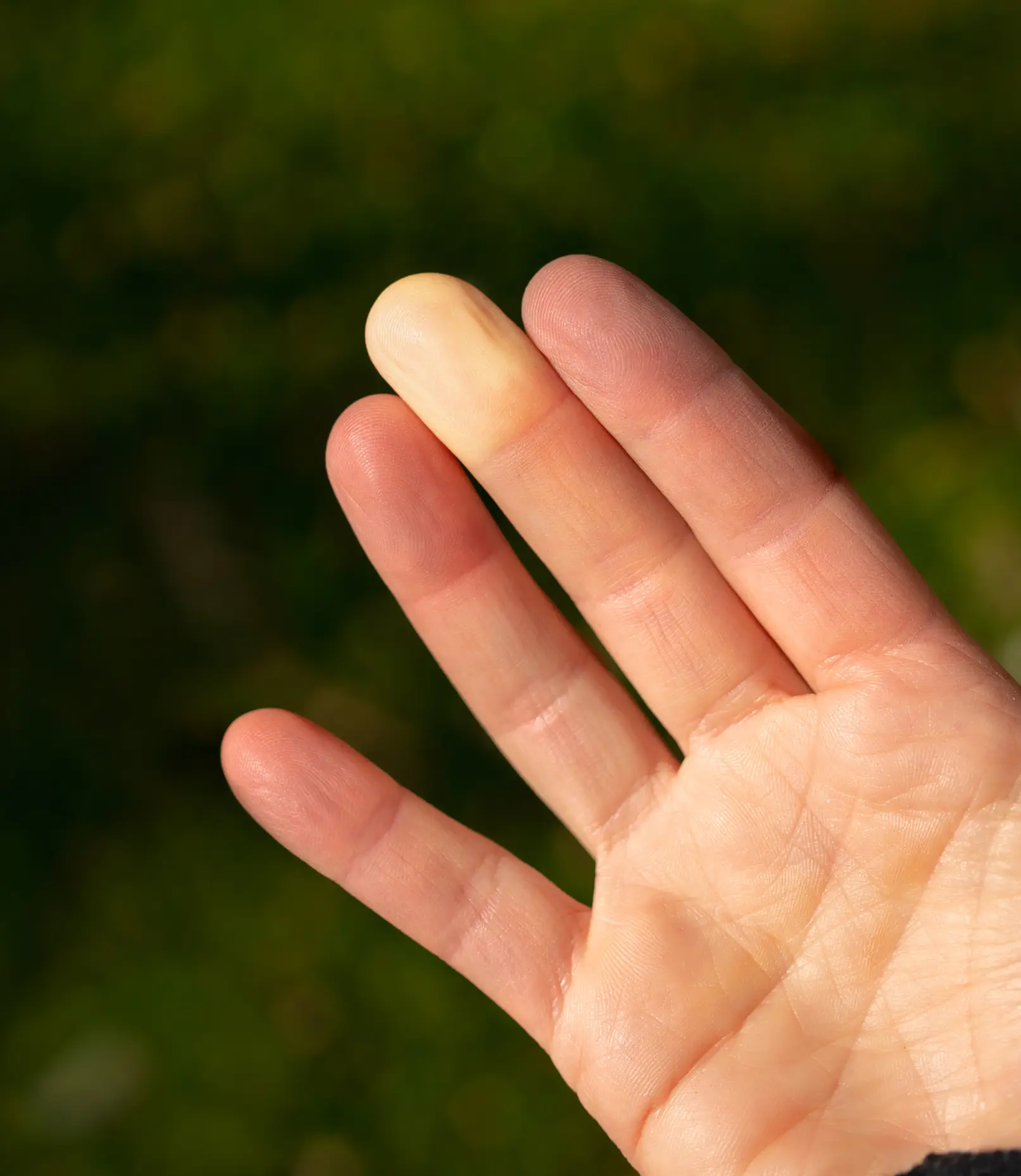 Fingers and toes changing colour is a symptom of Raynaud's (Getty Stock Images)