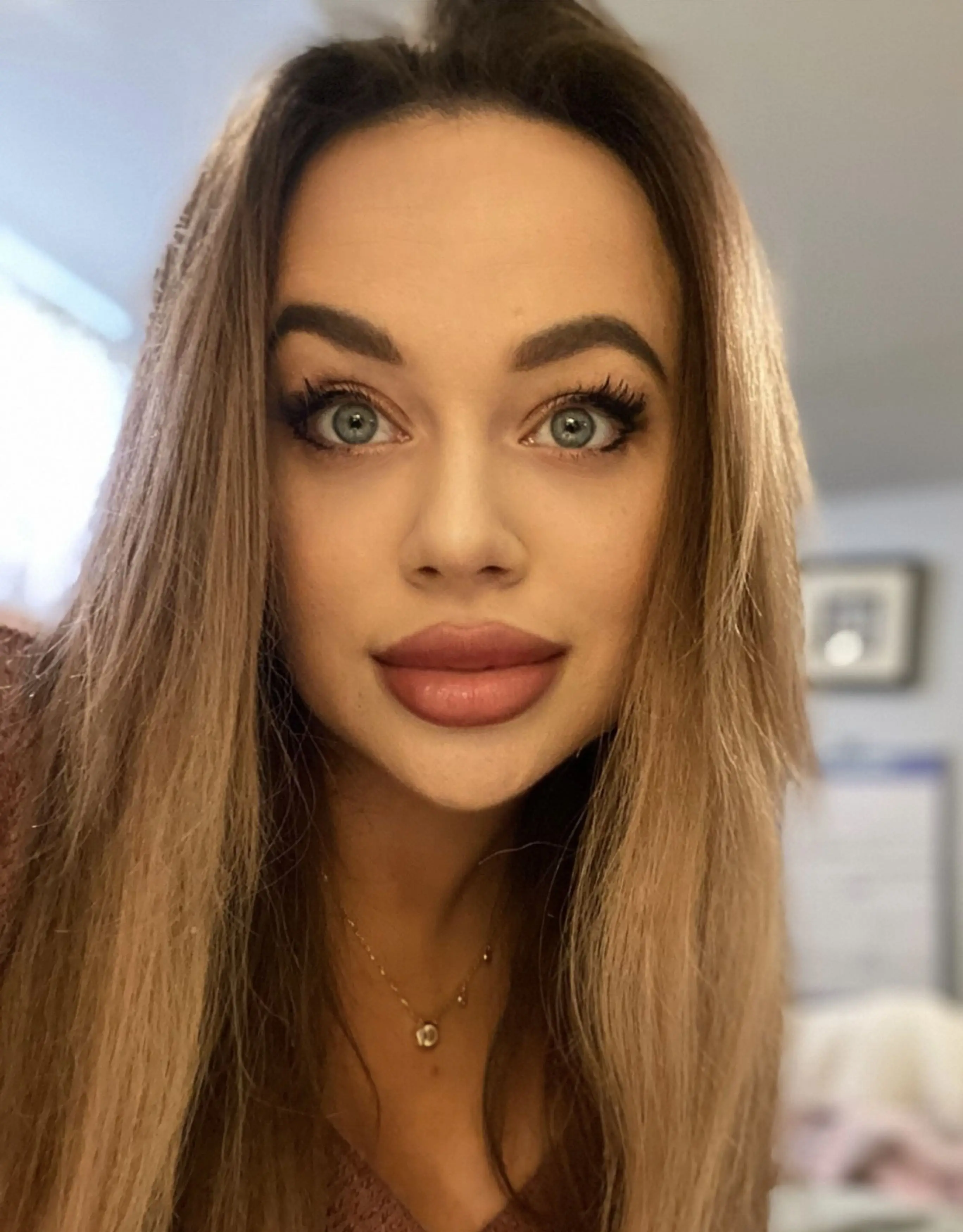 Julia Anderson almost lost her legs after passing out on her bed following a boozy night out (Kennedy News and Media)