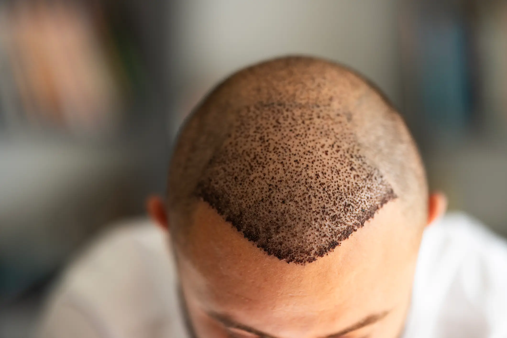 Hair transplants are becoming more and more popular (Getty Stock Image)
